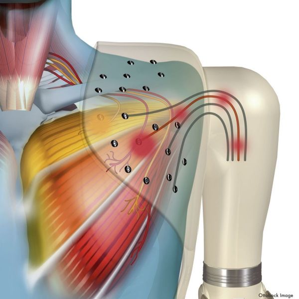 Targeted Muscle Reinnervation Reduces Limb Pain After Amputation